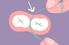 Step-by-step flossing technique showing floss curved around tooth and under gumline.
