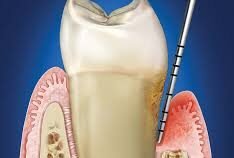 How to Tell If You Have Gum Disease